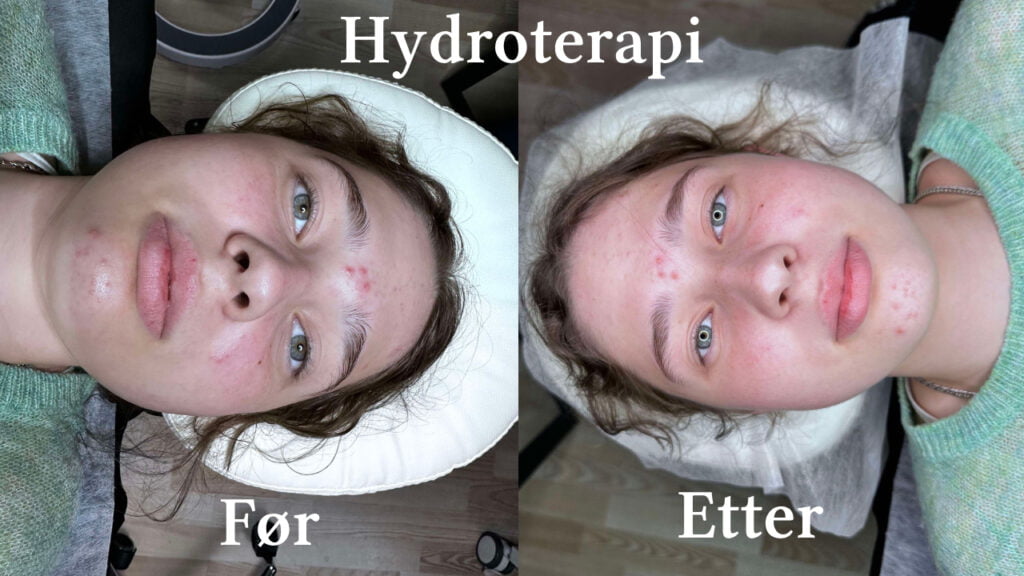 Hydroterapi for Ansiktet hos Vynnyk Massasje Studio i Rjukan: Hemmeligheten til Foryngelse og Effektivitet ved Regelmessige Behandlinger